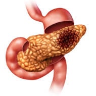 pancreatic cancer (Shutterstock)