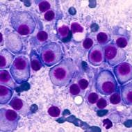 blood cancer cells